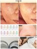 【究極の皮脂・ニキビ肌ケア】徹底毛穴洗浄×プラズマミストで肌質改善