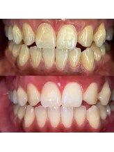 エール(aile)/うるま市セルフホワイトニング