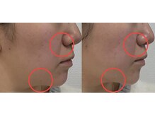 ライリー(Rairy)/最強肌質改善プラズマカリファEX