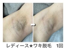 ナルシス/【脱毛】ワキ1回の変化★