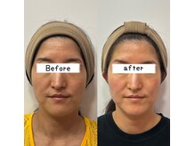 ウル 下北沢(Ulu)の雰囲気(リピート率98%!自信が持てるフェイスラインに♪#小顔#下北沢)