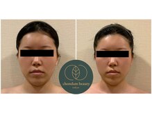 チョンダムビューティー(chondam beauty)/小顔コルギで輪郭もスッキリUP～