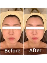 スペチアーレ 夙川/小顔、たるみ改善にオススメ