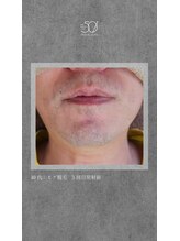 ゴーマルイチ(501)/メンズ脱毛　Before/After