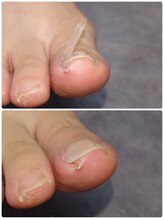 巻き爪じゅん 船橋店/巻き爪の痛み改善は早めがカギ