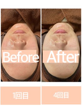 おうちサロン ミキ/BeforeAfterピーリング