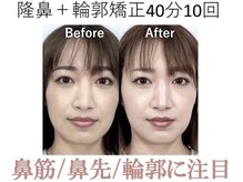 ラプリ 大阪心斎橋店(Raplit)/隆鼻＋輪郭矯正40分10回
