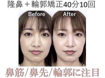 ラプリ 大阪心斎橋店(Raplit)/隆鼻＋輪郭矯正40分10回