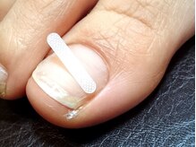 ネイルサロン リアン西葛西店/巻き爪矯正で辛さ解消