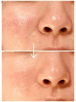 エステサロン クブ(Kubu)/光フェイシャル