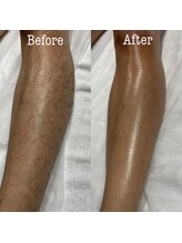 ア レーズ(a laise)/脚のダブル脱毛☆