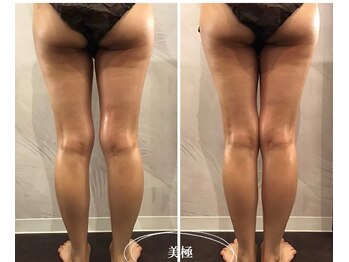 美極 銀座店/銀座/小顔コルギ/小顔矯正