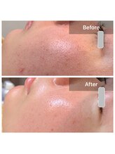 ブールドネージュ(Boule de Neige)/ハーブ/ハイドロ/プラズマ