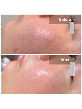 ブールドネージュ(Boule de Neige)/ハーブ/ハイドロ/プラズマ