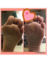 リゼラアンドコー 宇都宮店/タコ、ウオノメ、Before＆After