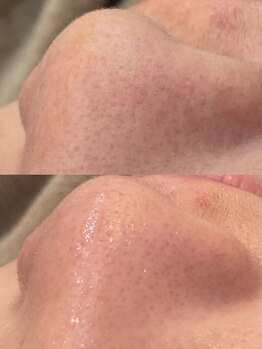 ルナート(Lunart)/毛穴洗浄/毛穴ケア