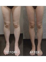 ブランシュムーニー(BRANCHE MOONY)/脂肪冷却とセル脂肪分解マシン