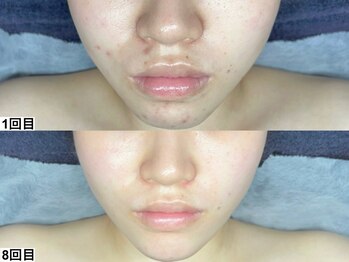 アンドミー 中百舌鳥(&me)/ララピール【艶肌/肌質改善】