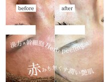 マハロ 大宮(Mahalo)の雰囲気（ニキビケア＆毛穴改善専門店★幹細胞ハーブピーリング取り扱い◎）