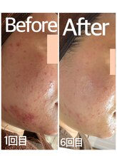 おうちサロン ミキ/BeforeAfterピーリング