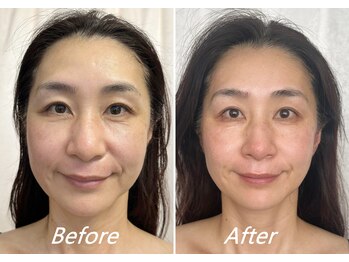 ドクターボディ 新宿店(Dr.Body)/【頬のたるみ/左右差/面長50代】