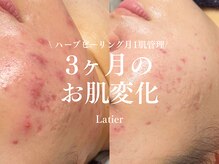 ラティエ(Latier)/ハーブピーリング3回目お肌変化