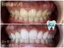 札幌セルフホワイトニング ラディアンス(Radiance)/ホワイトニング2ヶ月通い放題