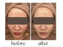 セレブリティ(Celebrity)の雰囲気（1度で効果絶大！お肌のくすみ・赤み・ニキビケアならララピール）