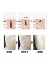 サロンドベルム(Salon de BELME)/シミケア後の経過★