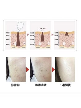 サロンドベルム(Salon de BELME)/シミケア後の経過★