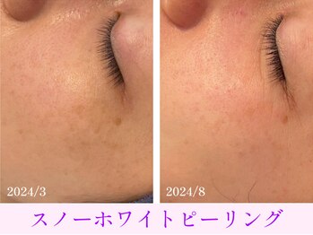 オーシャンブルー 日田店/シミくすみケアスノーピーリング