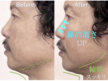 ラプリアンジュ 鹿児島天文館店(Raplit ange)/隆鼻+輪郭矯正40分20回