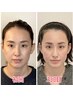 人気No. 1【面長矯正】～メスを使用せず骨格を変える美容施術～当サロン考案