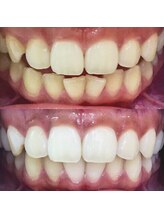 LBSホワイトニング 錦糸町店/ホワイトニングビフォーアフター