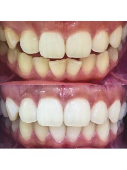 LBSホワイトニング 錦糸町店/ホワイトニングビフォーアフター