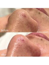 イリマレイサロン(iLima Lei SALON)/毛穴洗浄でお肌を掃除