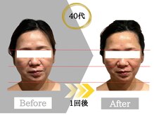 ジャパ(JAPA)/話題のレッドショットで小顔に♪