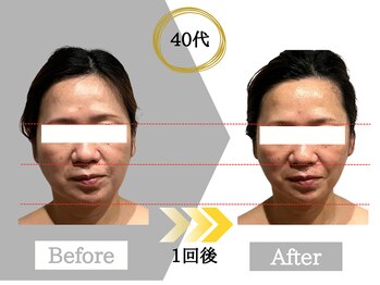 ジャパ(JAPA)/話題のレッドショットで小顔に♪