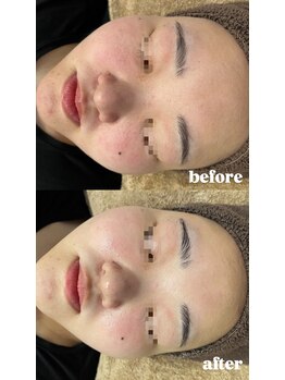 エクラ(ECLAT)/ピーリング×クールビタミン導入