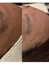 ルルアス(LuLu AS)/ララピール幹細胞月一1年間