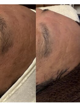 ルルアス(LuLu AS)/ララピール幹細胞月一1年間