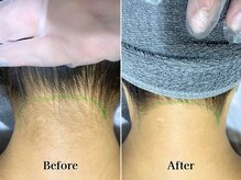 ライズ 札幌店(RISE)/うなじ・襟足のダブル脱毛