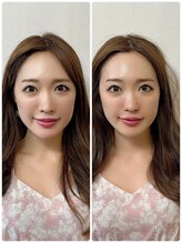 メディカルエース(MedicalAce)/脂肪増殖でベビーフェイス