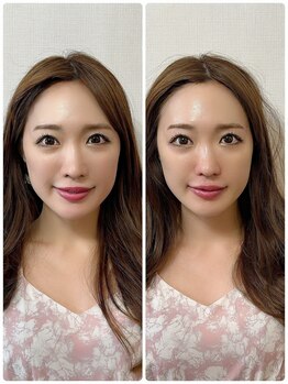 メディカルエース(MedicalAce)/脂肪増殖でベビーフェイス