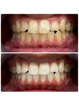 エクシアホワイトニング 日本橋店/莫大な効果