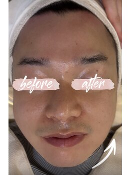 ミピマム 恵比寿店(Mipimam)/30代男性 半顔変化写真