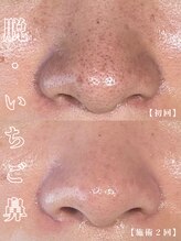 ゼアー(THERE FY.)&nbsp;ハイドロ 毛穴洗浄