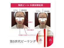 メロー(MELLOW)の雰囲気（《人気爆発中》REVI陶肌ピール☆自分史上最高艶肌へ/毛穴/ニキビ）