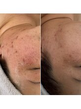 リュミエール(Lumie're)/シミ、毛穴、ピーリング