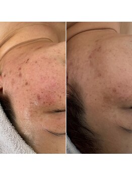 リュミエール(Lumie're)/シミ、毛穴、ピーリング